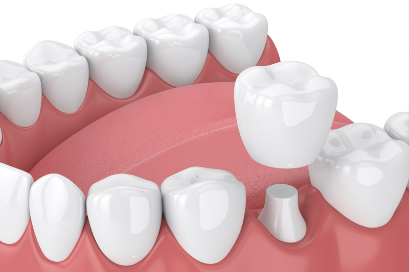 Dental Crowns in Wappingers Falls