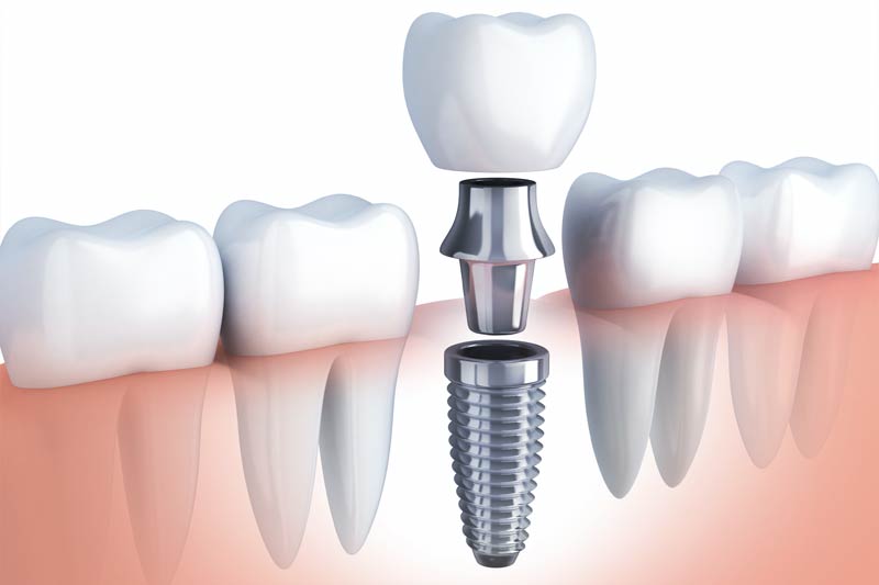 Implants Dentist in Wappingers Falls