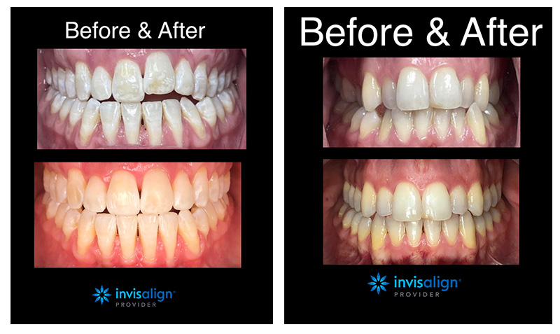 Invisalign in Hudson Valley