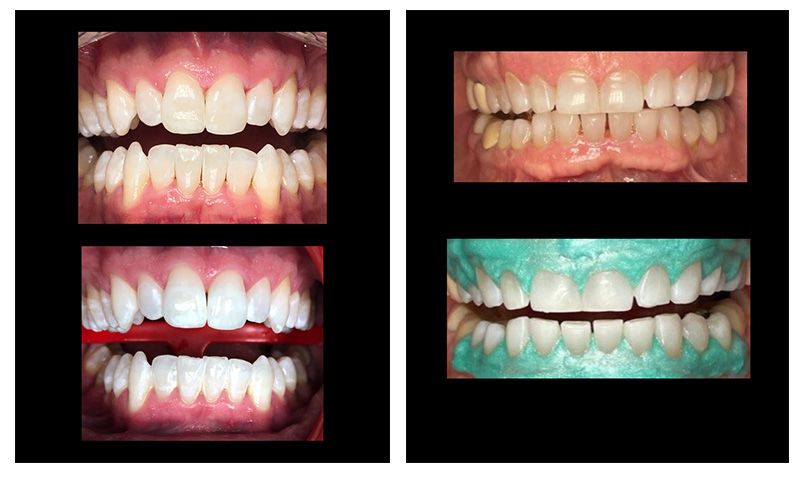 KoR Teeth Whitening in Wappingers Falls