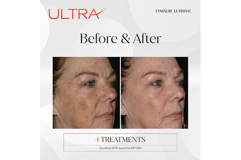 Facial Spa Treatment - LaseMD Ultra in Wappingers Falls