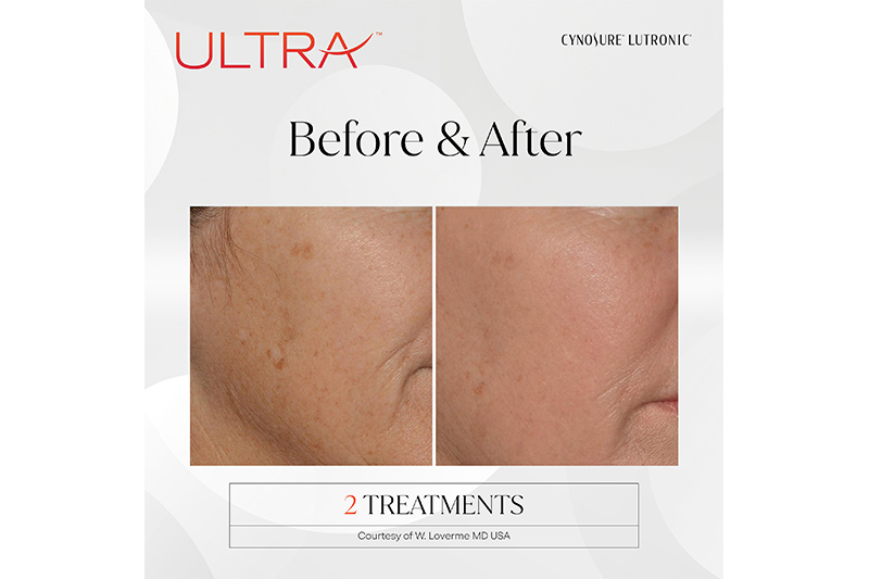 Facial Spa Treatment - LaseMD Ultra in Wappingers Falls