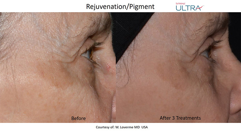Facial Spa Treatment - LaseMD Ultra in Wappingers Falls