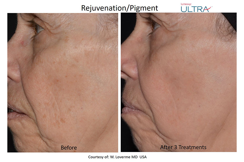 Facial Spa Treatment - LaseMD Ultra in Wappingers Falls