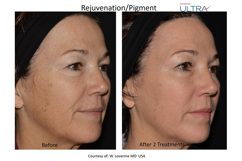 Facial Spa Treatment - LaseMD Ultra in Wappingers Falls