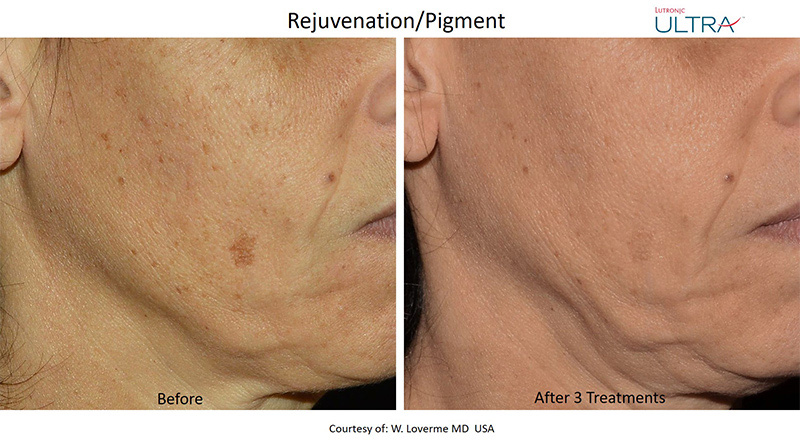Facial Spa Treatment - LaseMD Ultra in Wappingers Falls