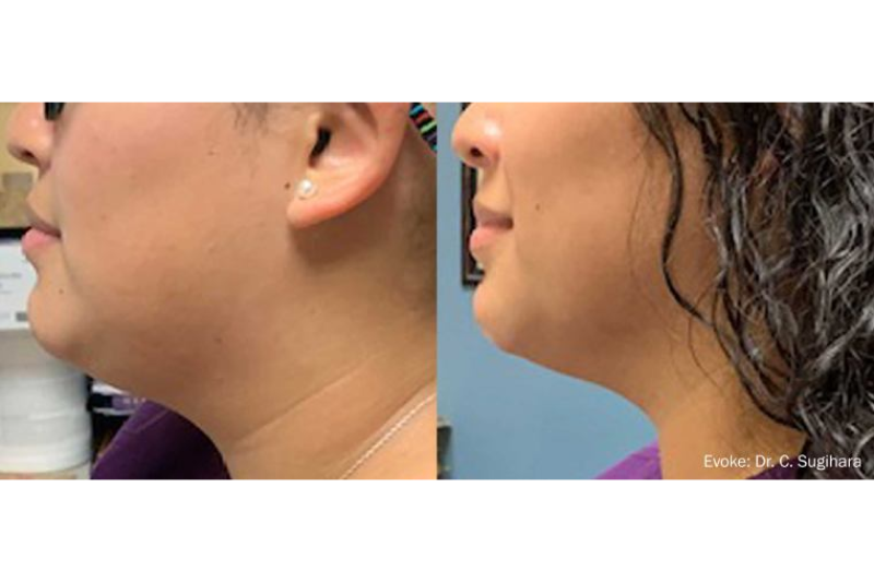 Facial Spa Treatment - Evoke Facial Remodeling in Wappingers Falls