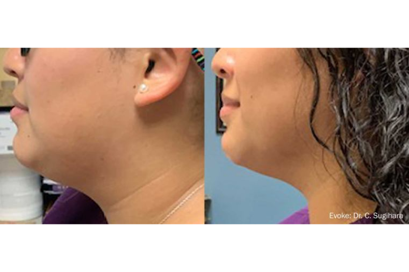 Evoke Facial Remodeling and Lase MD in Wappingers Falls