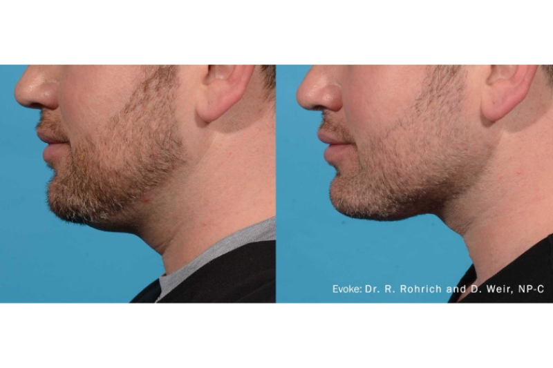 Evoke Facial Remodeling and Lase MD in Wappingers Falls