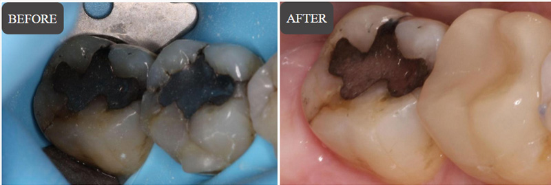 Inlays And Onlays in Wappingers Falls