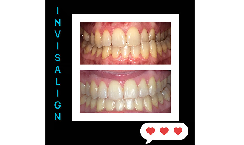 Invisalign in Wappingers Falls